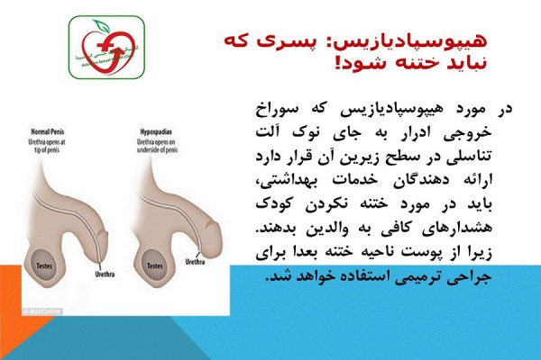 هیپوسپادیازیس: پسری که نباید ختنه شود!