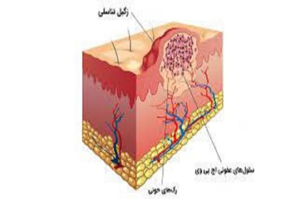 زگیل تناسلی