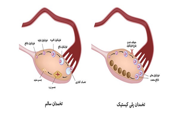 تشخیص سندرم تخمدان پلی‌کیستیک