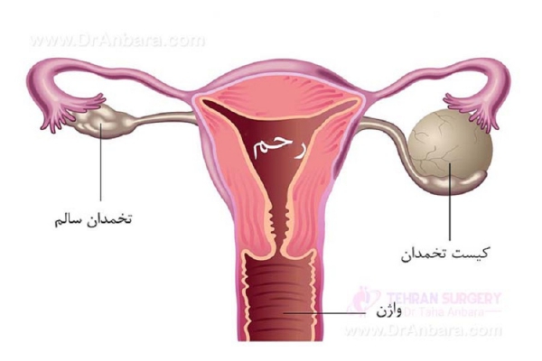 کیست تخمدان:عوارض و درمان آن