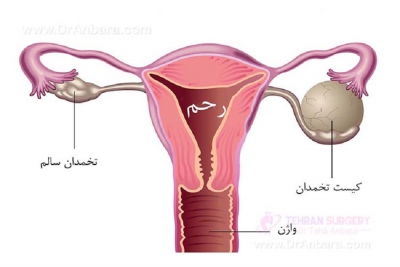 کیست تخمدان:عوارض و درمان آن
