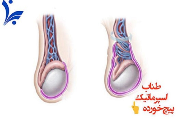 پیچ‌خوردگی بیضه چیست؟