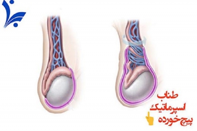 پیچ‌خوردگی بیضه چیست؟