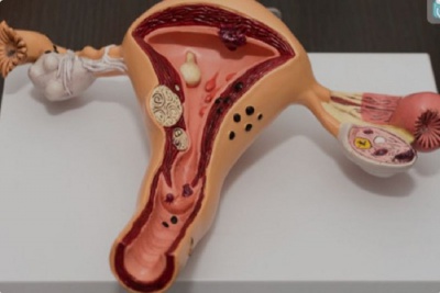 عملکرد جنسی در زنان مبتلا به سرطان رحم، تخمدان و پستان