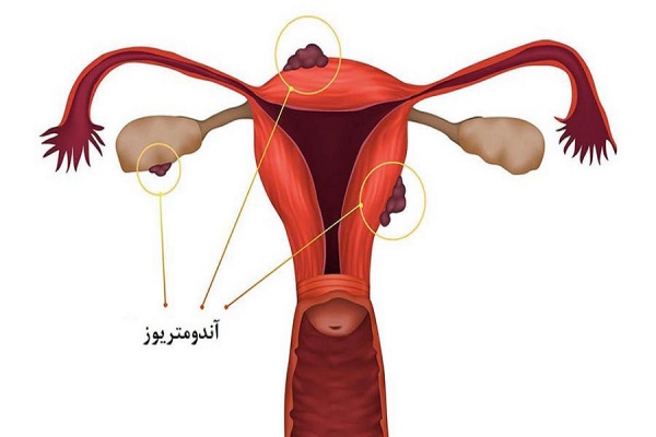 اندومتریوز از بیماری های شایع ناباروری زنان است