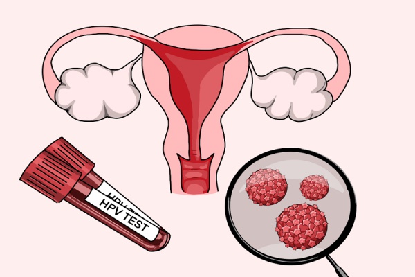 غربالگری HPV و پاپ اسمیر؛ چرا باید جدی گرفته شود؟