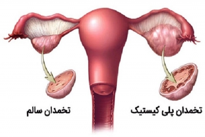 آیا بیماری سندرم تخمدان پلی‌کیستیک وراثتی است