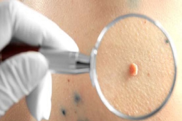 هرآنچه باید درباره زگیل تناسلی (hpv) بدانید