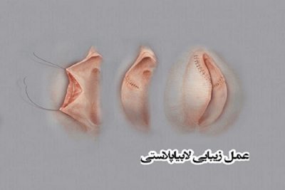 همه چیز درباره لابیا پلاستی