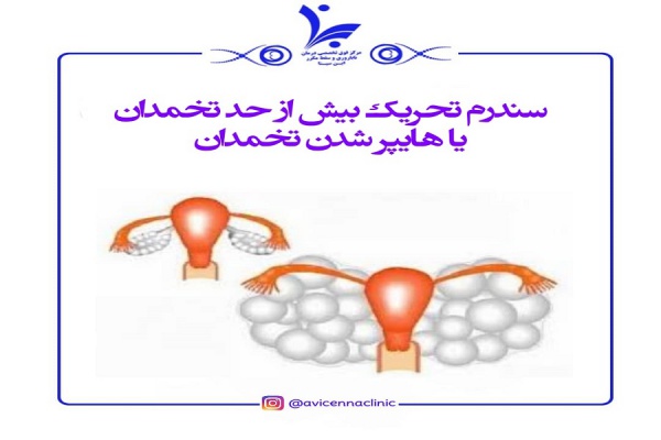 سندرم تحریک بیش از حد تخمدان (OHHs) یا هایپر شدن تخمدان