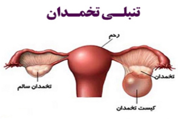 تنبلی تخمدان شایع‌ترین بیماری غدد درون‌ریز خانم‌های جوان