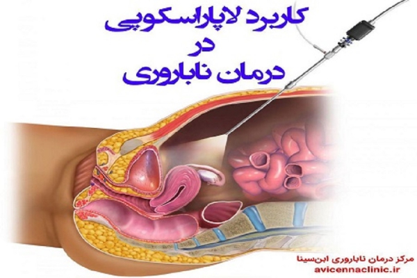 کاربرد لاپاراسکوپی در درمان ناباروری